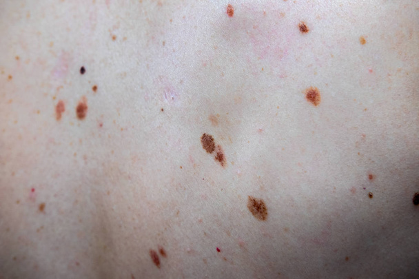 Melanocytic nevus, some of them dyplastic or atypical, on a caucasian man of 36 years old - Photo, Image