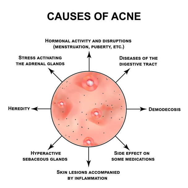 Causes of acne. Pustules, papules, comedones, blackheads, acne on the skin. Infographics. Vector illustration on isolated background. - Vector, Image