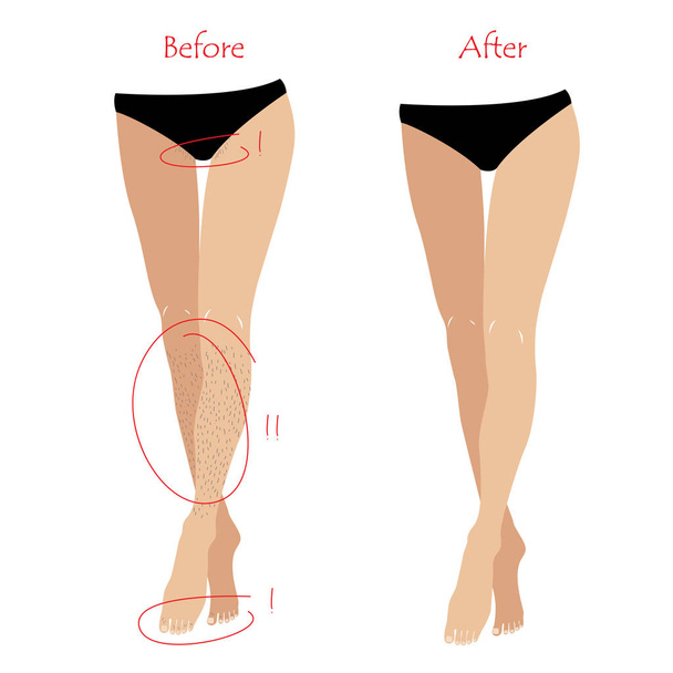 Woman epilation or depilation concept - legs and bikiny zone before and after unwanted hair removing. Vector - Vektori, kuva