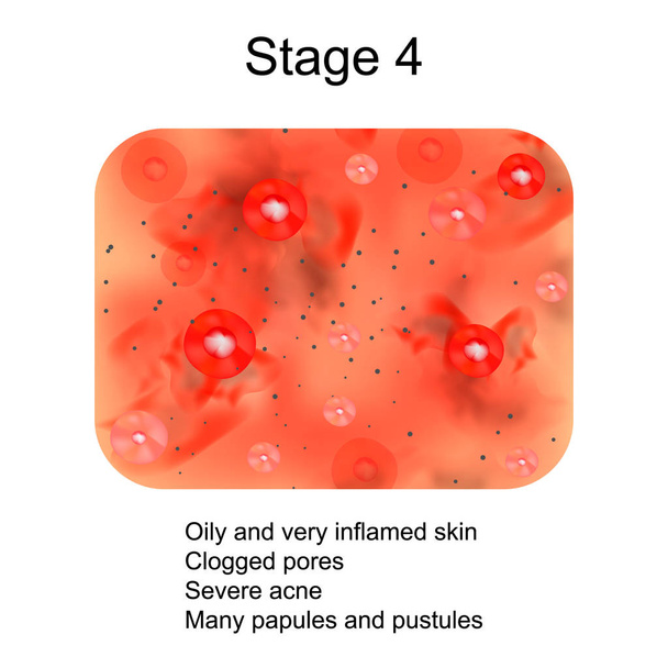 Etapa 4 del desarrollo del acné. Piel inflamada con cicatrices, acné y granos. La textura de la piel inflamada, acné y granos. Infografías. Ilustración vectorial
. - Vector, imagen