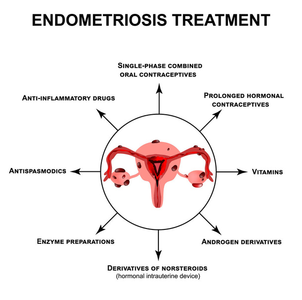 Az endometriózis kezelése. Adenomyosis. A szerkezet a kismedencei szervek endometriózis. Infographics. Vektoros illusztráció elkülönített háttéren. - Vektor, kép