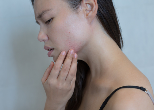 Gestreste vrouw breken met acne op haar gezicht. - Foto, afbeelding