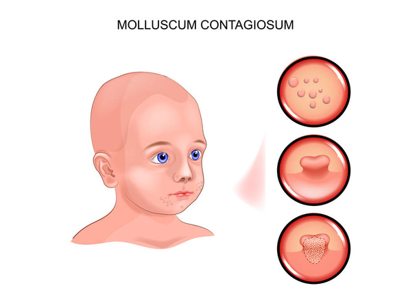 Molluscum contagiosum in a child. - Vector, Image