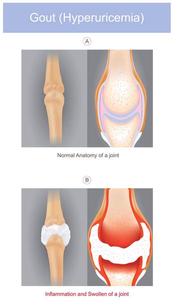 Dna. Ilustrované formy artritidy, které mohou být intenzivně - Vektor, obrázek