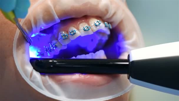 Dentista corrige aparelhos com uma lâmpada infravermelha. Fecha. Efeito de movimento lento
 - Filmagem, Vídeo