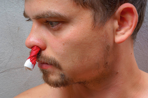 Saignement du nez d'un jeune homme. Tension artérielle chez les hommes. Serviette blanche dans le nez de l'homme. Arrêtez les saignements nasaux
 - Photo, image