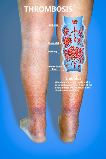 Крупним планом шкіра з варикозним розширенням вен
 - Фото, зображення