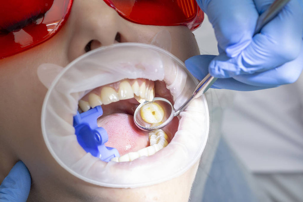 treatment of tooth decay. girl at the reception at the dentist. the doctor drilled a tooth boron machine removed caries. the tooth is prepared for applying a filling material. - Foto, Imagen