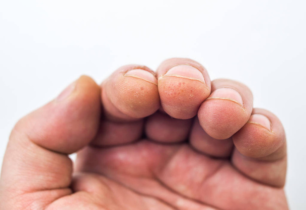 Расширенная стадия дишидроза на пальцах, потрескавшаяся и шелушащаяся кожа, белый фон. Аллергия на кожу
 - Фото, изображение