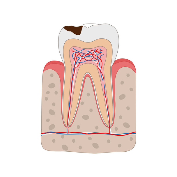 ungesunder Zahn mit Hohlraum isoliert auf weißem Hintergrund. medizinische zahnärztliche Plakatillustration in flachem Design. - Vektor, Bild
