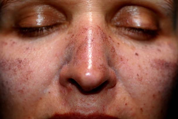 Manchas pigmentadas en la cara. Pigmentación en las mejillas
 - Foto, Imagen