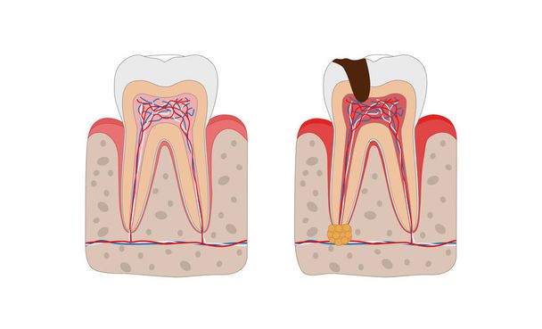 Zdravý zub a nezdravý zub se zubním útlumu a zubařskými abscety infografické prvky izolované na bílém pozadí. Lékařský zubní plakát ilustrace v plochém designu. - Vektor, obrázek