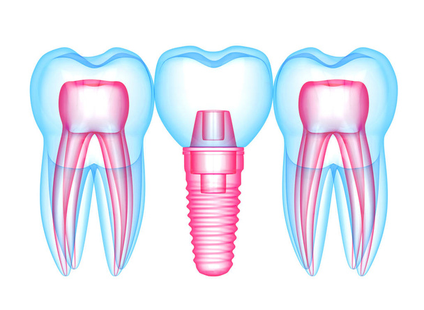 3d render of teeth with dental implant over white  - Fotó, kép