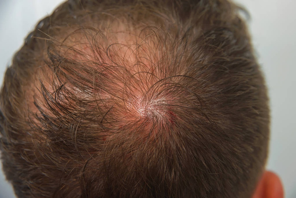 der Typ in der Arztpraxis. Männliche Glatzenbildung. Mesotherapie der Kopfhaut. Glatze auf dem Kopf des Mannes. - Foto, Bild