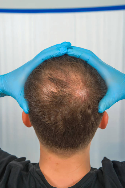 Хлопець у синьому латексі тримає голову. Чоловічого облисіння. Мезотерапія волосистої частини голови. Лисий на голові людини. - Фото, зображення