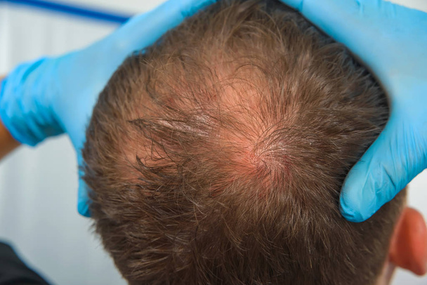 Mann in blauem Latex hält seinen Kopf. Männliche Glatzenbildung. Mesotherapie der Kopfhaut. Glatze auf dem Kopf des Mannes. - Foto, Bild