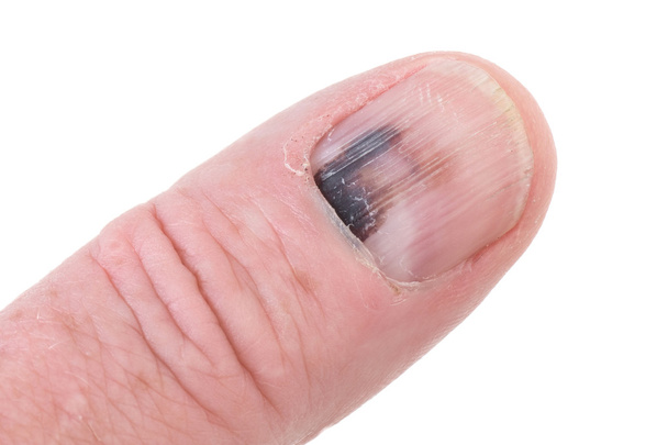 Забій пальця нігті
 - Фото, зображення