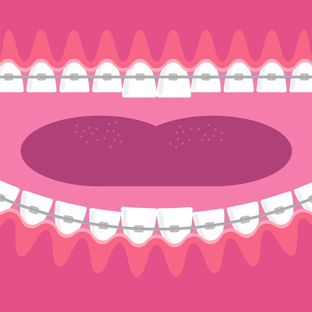 Braces Teeth. Dental Care Background. Orthodontic Treatment. Cartoon Opening Mouth. - Vector, Image