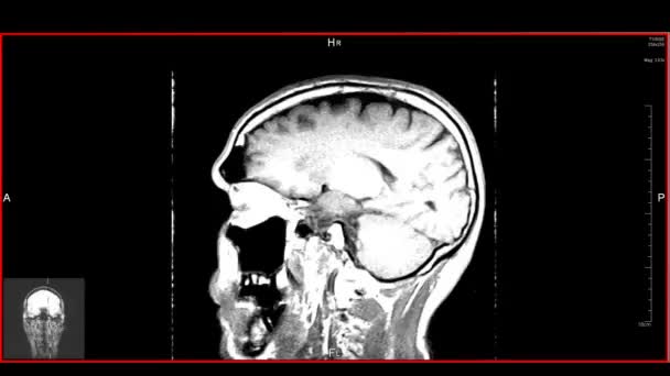 Brain Top MRT-Scan. Diagnosztikai orvostechnikai eszköz (hurok) - Felvétel, videó