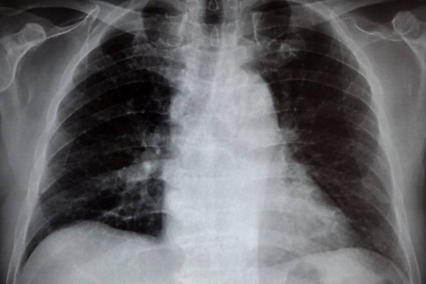 Рентген грудной клетки
  - Фото, изображение