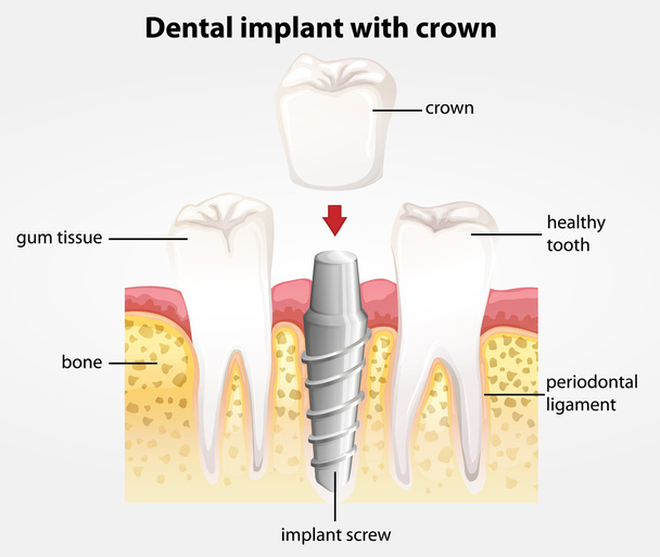 Dental implant z koroną - Wektor, obraz