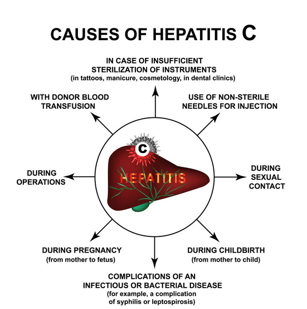 Causas de la hepatitis C. Día Mundial de la Hepatitis. Infografías. Ilustración vectorial sobre fondo aislado
. - Vector, imagen