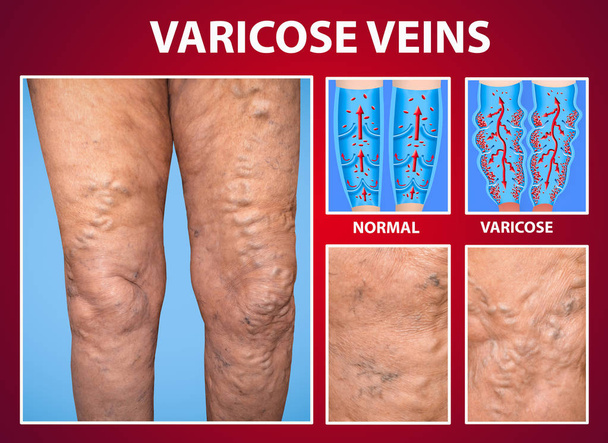 Las venas varicosas en las piernas de la mujer
 - Foto, Imagen