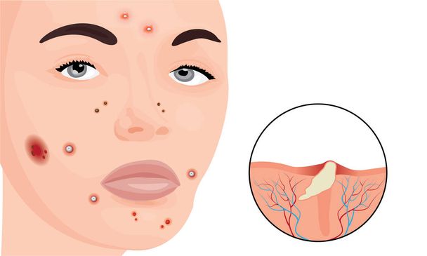 L'acné sur un visage de femme
 - Vecteur, image