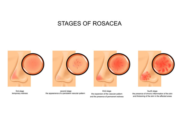 stadia van rosacea - Vector, afbeelding