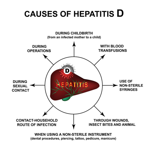 Hepatiitti D:n syyt Maailman hepatiittipäivä. Infografiikkaa. Vektorin kuva eristetyllä taustalla
. - Vektori, kuva