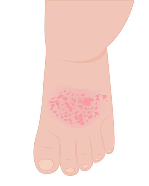 Um pé de bebê afetado com eczema
  - Vetor, Imagem