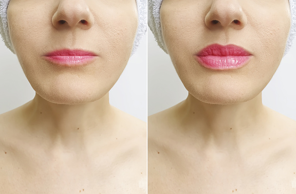 lèvres de femme avant et après l'augmentation - Photo, image