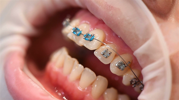 Hammaslääkäri laittaa purkkaa hammasrautoihin hammashoitolassa. Äärimmäinen lähikuva
 - Materiaali, video