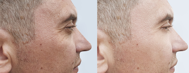miesten kasvojen ryppyjä ennen hoitoa ja sen jälkeen
 - Valokuva, kuva