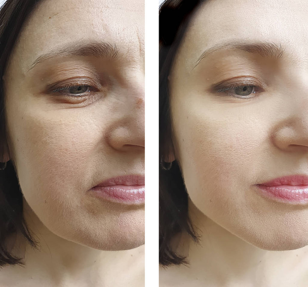 žena tvář vrásky před a po ošetření - Fotografie, Obrázek