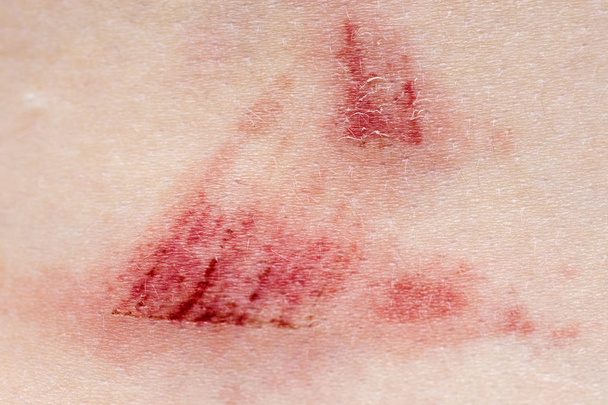 A wound on the human body. Very close up of painful wound - Photo, Image