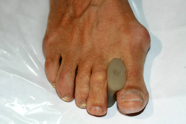 Correction of the curvature of the toe - Photo, Image