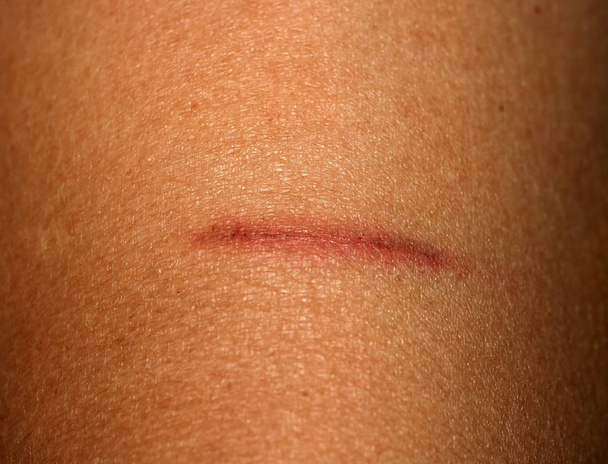 Cut on the skin. Wound, abrasion, scratch - Photo, Image