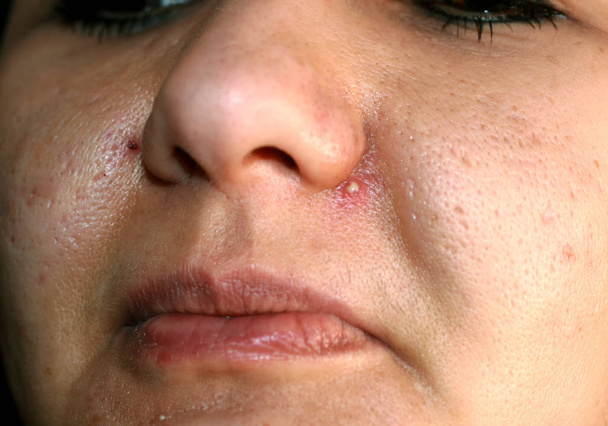 顔の皮膚が炎症を起こしています。にきび。鼻に化膿性のにきび. - 写真・画像