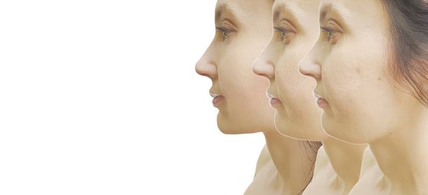 治療前と治療後の女性の二重あご - 写真・画像