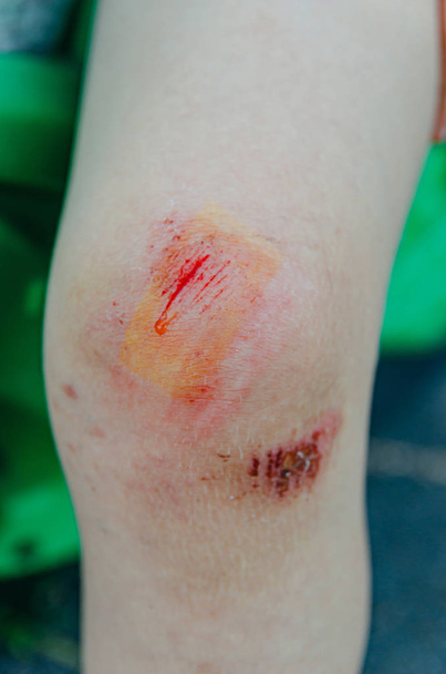 Kind rannte, stürzte und schnitt sich die Knie. ein kleiner Junge im Sommerurlaub - Foto, Bild