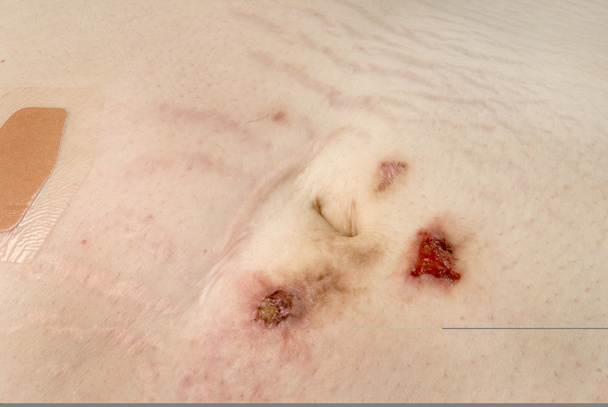 Open Wound - Photo, Image