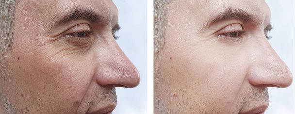 mies kasvot ryppyjä ennen hoitoa ja sen jälkeen - Valokuva, kuva