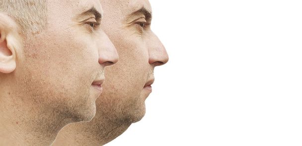 чоловічий подвійний підборіддя до і після лікування
 - Фото, зображення
