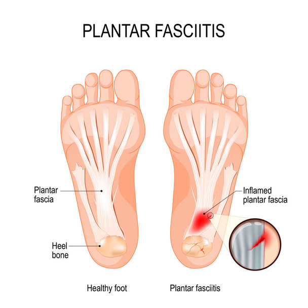 Plantar fasciitis. disorder of the connective tissue which suppo - Vector, Image