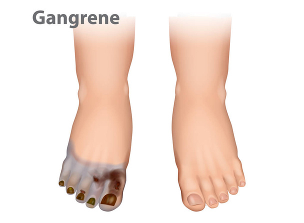 La gangrena es un tipo de muerte tisular causada. Enfermedad arterial diabética que muestra gangrena y ulceraciones en los dedos de los pies
. - Vector, imagen