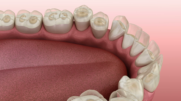 Dentystyczne ścieranie (bruksizm) w wyniku utraty tkanki zęba. Medycznie dokładna animacja 3D zębów - Materiał filmowy, wideo