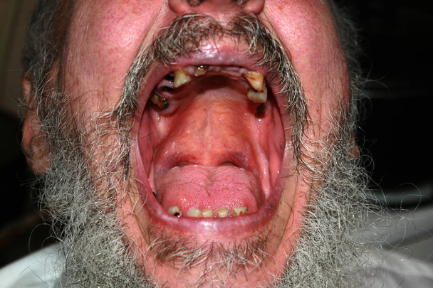 Rotten bad teeth. Beard and mustache. Caries. Periodontal disease. Dental tartar. - Fotografie, Obrázek