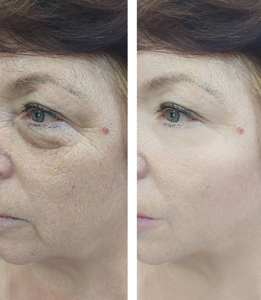 face of an elderly woman before and after treatment - Photo, Image