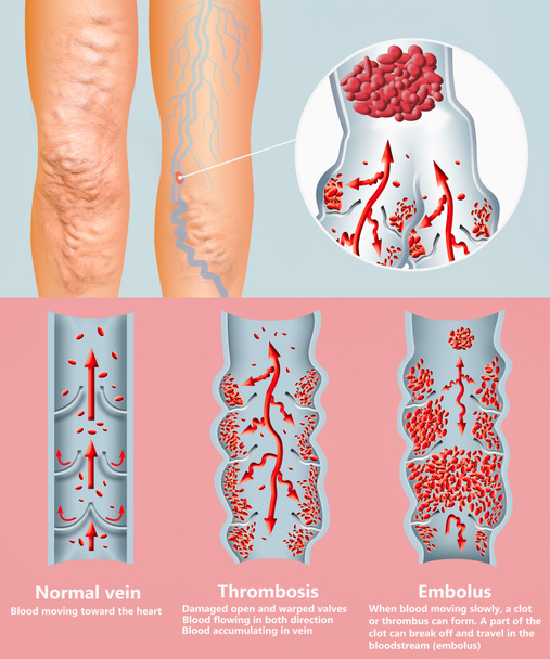 Diep-veneuze trombose of bloedstolsels. Embolus. - Foto, afbeelding